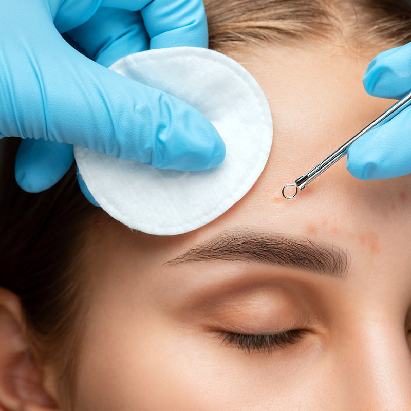 Blackhead & Pimple Removal Tool - Deep Cleansing