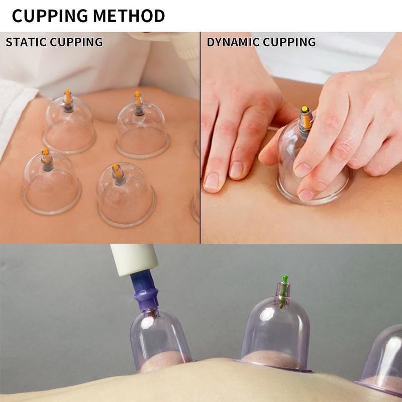 Cupping Set For Massage Therapy