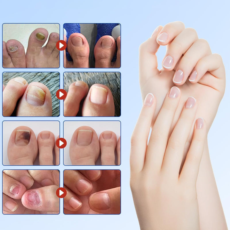 Fungal Nail Patches (21 pcs/box)