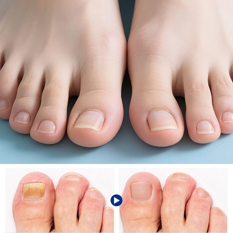 Fungal Nail Patches (21 pcs/box)