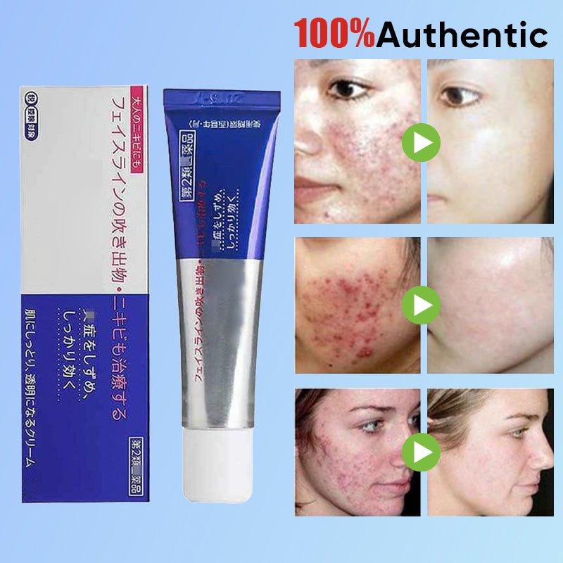 Gentle Antibacterial Acne Cream