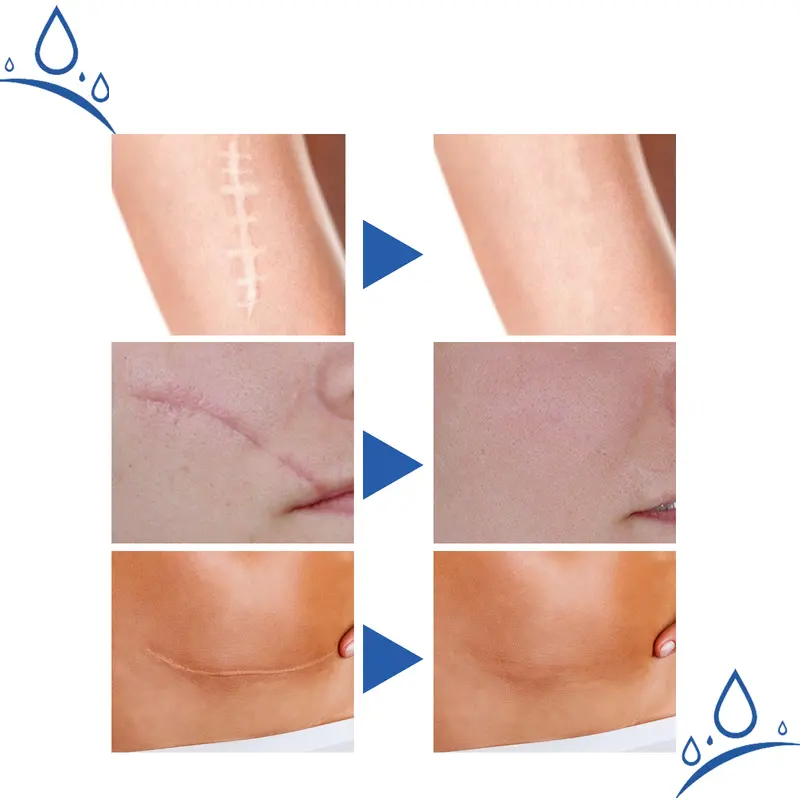 Professional Scar Removal Gel