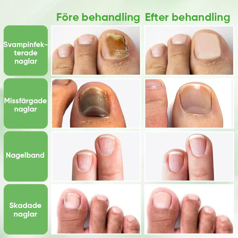 Ingefära nagelbehandling