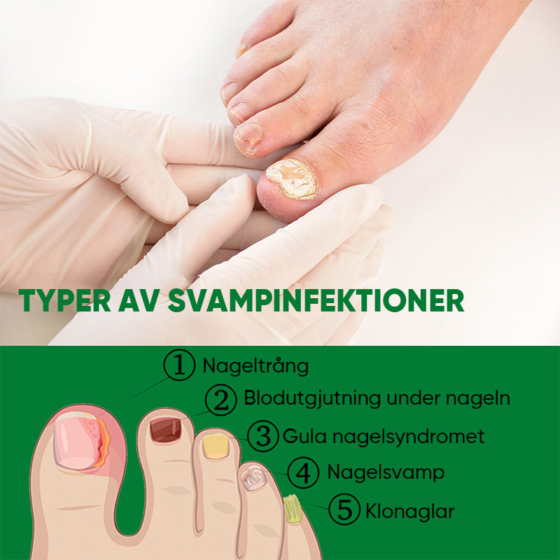 Ingefära nagelbehandling