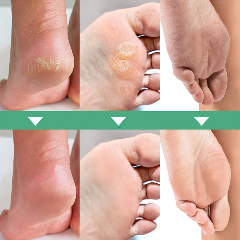 Exfoliating Foot Mask