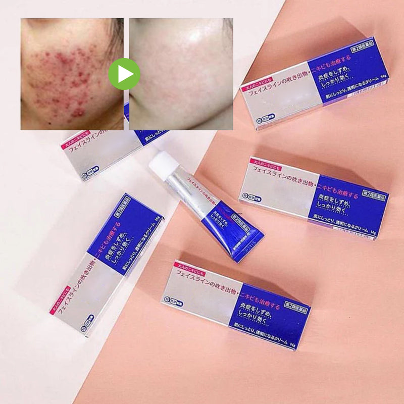 Gentle Antibacterial Acne Cream