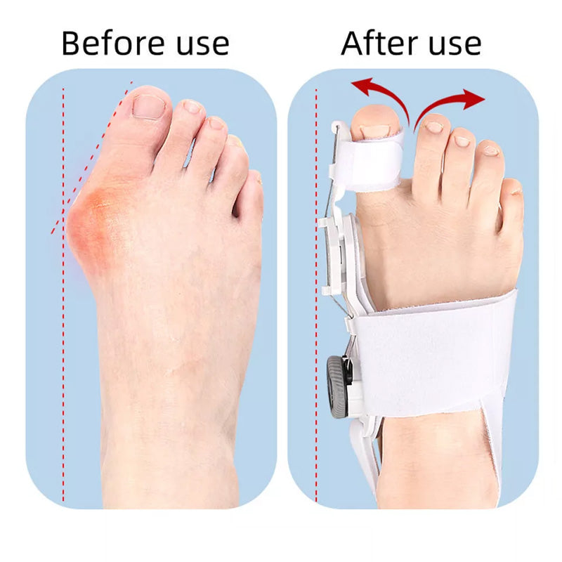 Upgraded Bunion Corrector
