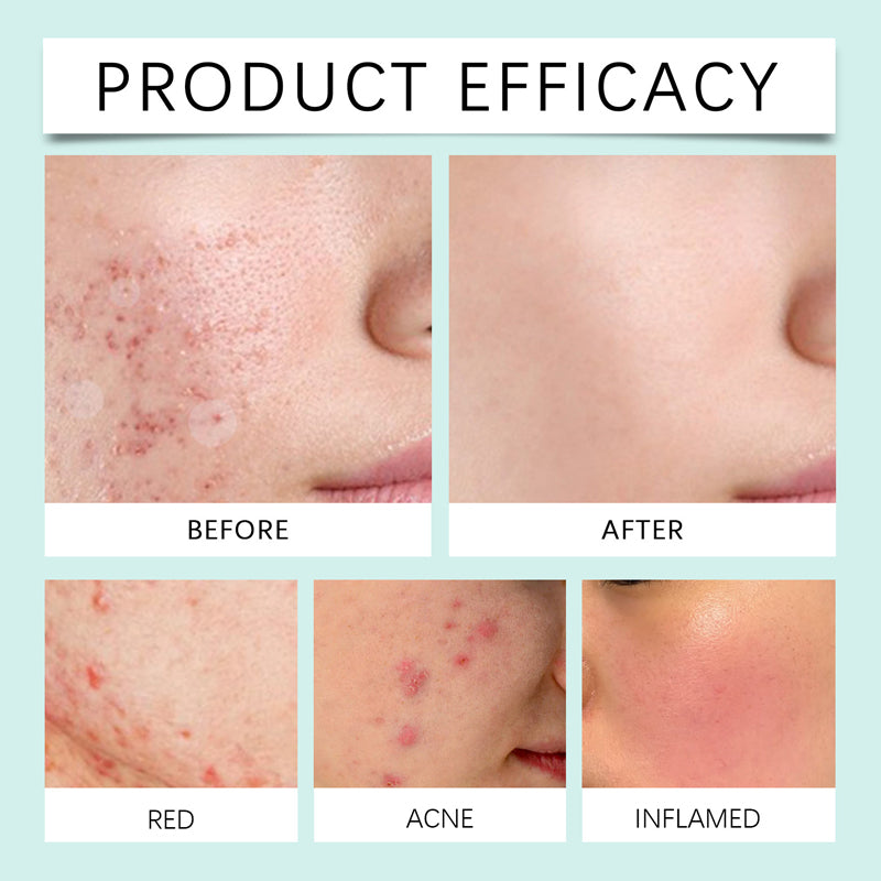 Acne Patch Skin Care Set